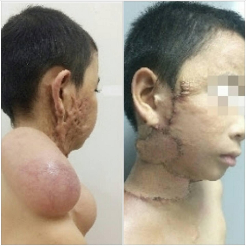 Túi giãn da được nuôi cấy để lấy da che phủ khi can thiệp cắt bỏ sẹo thừa. Sau phẫu thuật, vết sẹo lồi co kéo của bệnh nhi đã được xử lý. Ảnh: BS cung cấp.