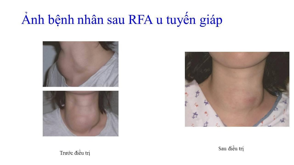 
Bệnh nhân sau điều trị u tuyến giáp bằng sóng cao tần, khối u nhỏ hoàn toàn, bệnh nhân không để lại vết tích can thiệp trên da. Ảnh: BS cung cấp.
