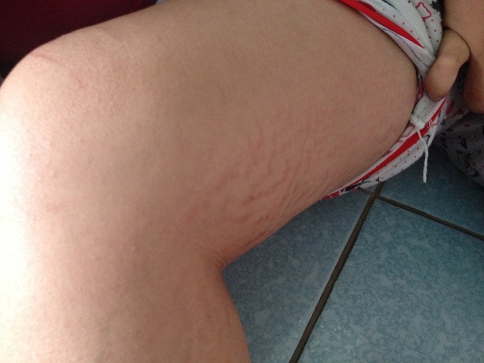 Căn bệnh khiến Thư thường xuyên bị xuất huyết nội, xuất huyết dưới da ở các vùng nhạy cảm nên lúc nào cũng có những mảng da vằn vện, bầm máu