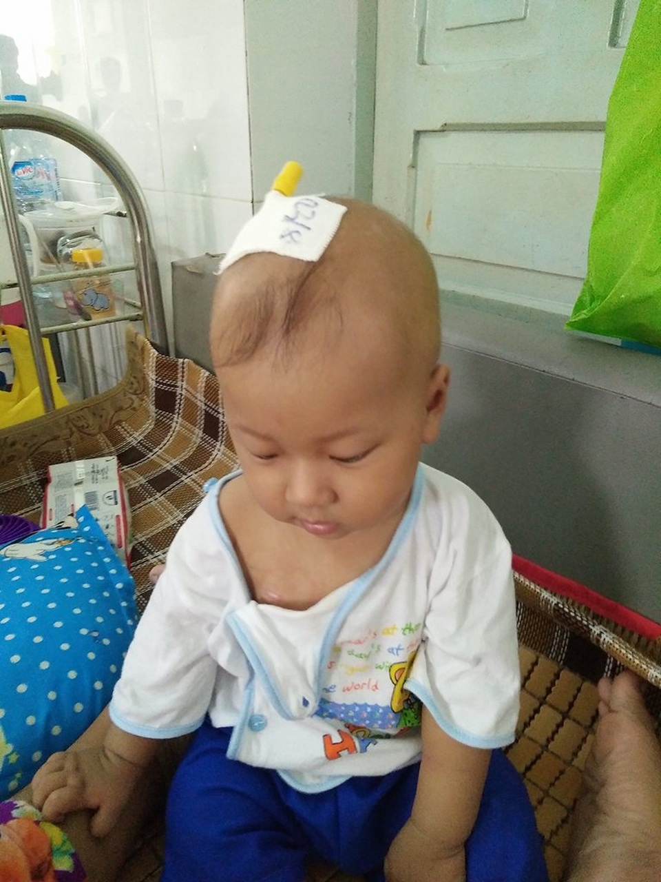Bé trai gần 2 tuổi đứng trước ngưỡng cửa sinh tử vì bệnh hiểm nghèo - 2 Vì ven bé lặn, khó tìm nên có lúc bắt ven ở đầu...