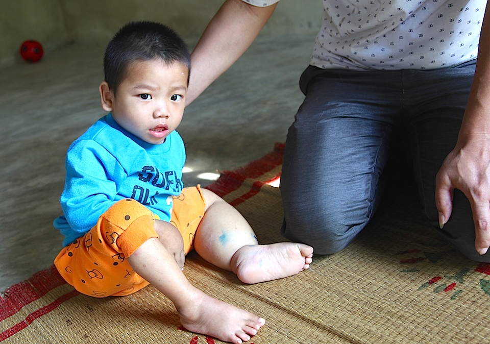 Hơn 52 triệu đồng đến với bé 3 tuổi mang nỗi đau phì đại chân tay - 4 Bé Minh sinh ra là đã làm bạn với dao kéo phòng mổ và thuốc thang.