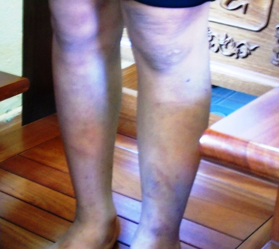 Bé gái bị bố đánh dã man: Bị đánh vì sang chơi với mẹ? - 3
Đôi chân của bé T. đã đỡ hơn nhiều sau nhiều ngày được điều trị tại bệnh viện.