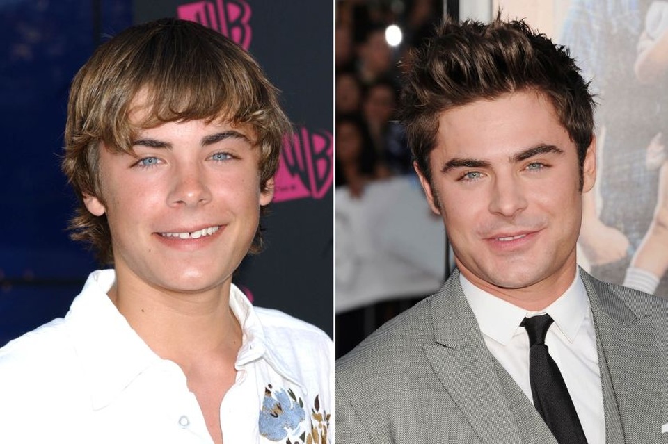 Nam diễn viên Zac Efron từng trở nên nổi tiếng với loạt phim truyền hình ca nhạc “High School Musical”. Vẻ đẹp trẻ trung ở nhân vật cậu nam sinh ngày ấy giờ đã nhường chỗ cho vẻ nam tính, chững chạc của một người đàn ông 28 tuổi. Thêm nữa, hai chiếc răng cửa cách xa nhau của Zac Efron hiện giờ đã được “thẩm mỹ” để trở nên duyên hơn.