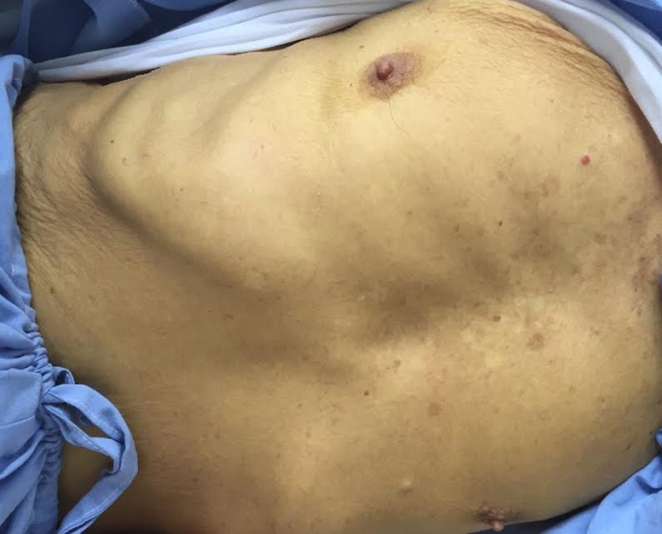 
Bệnh nhân D sau nội soi mật tụy ngược dòng đã hết vàng da
