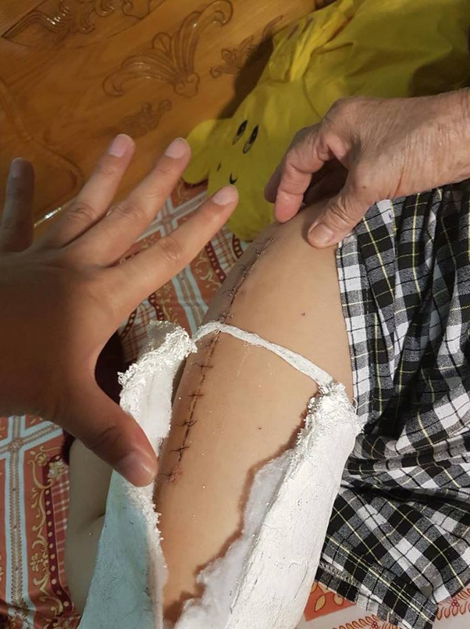 Vụ học sinh gãy chân trong sân trường: Nhà trường phản hồi - 1 Vết khâu trên chân cháu Kiên