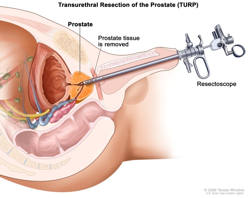 Phẫu thuật u xơ tuyến tiền liệt – chấm dứt “nỗi đau khổ” của quý ông - 2 Phẫu thuật nội soi cắt u xơ tuyến tiền liệt được áp dụng rộng rãi với nhiều ưu điểm như: không để lại sẹo, ít đau, phục hồi nhanh.