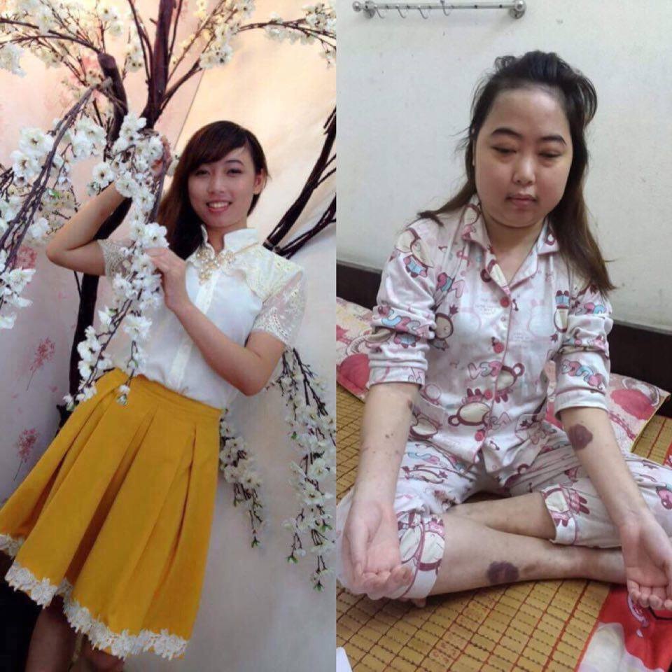 Cô gái trẻ Nguyễn Thị Loan trước khi bị bệnh và hiện tại