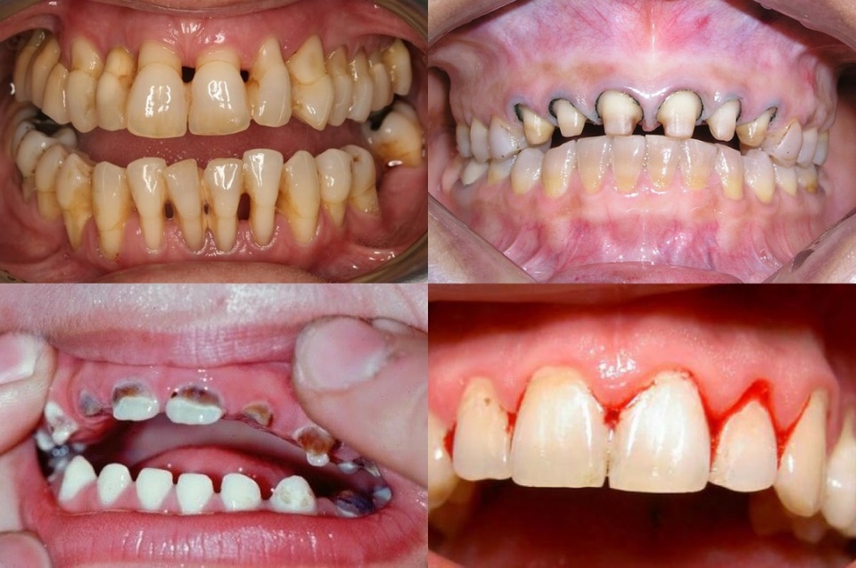 Cẩn trọng “ Tiền mất tật mang” vì ham bọc răng sứ giá rẻ - 1 Hỏng cả hàm răng chỉ vì ham bọc răng sứ giá rẻ
