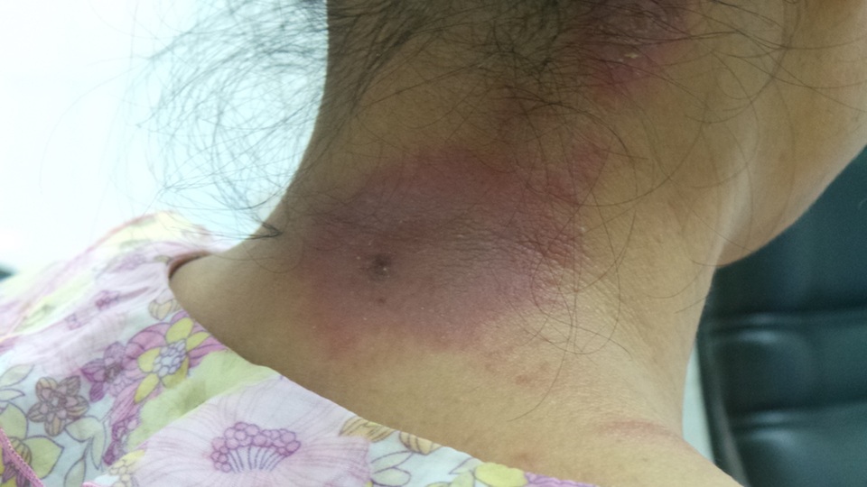 
Một bệnh nhân đến khám tại Bệnh viện Da liễu TW sau khi lầm tưởng bị mắc bệnh zona thần kinh.
