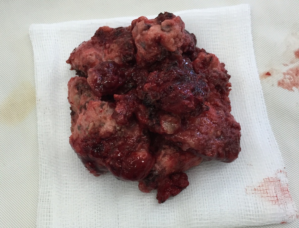 Khối khối u não của bệnh nhân Thường được phẫu thuật lấy ra.