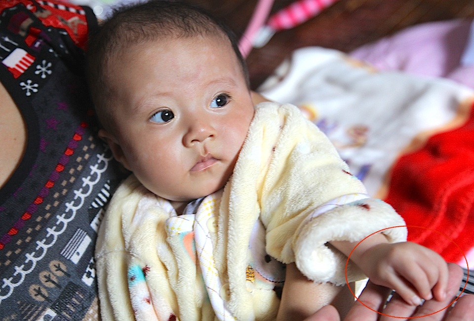 Tay cháu Anh Đài các ngón đều co quắp.