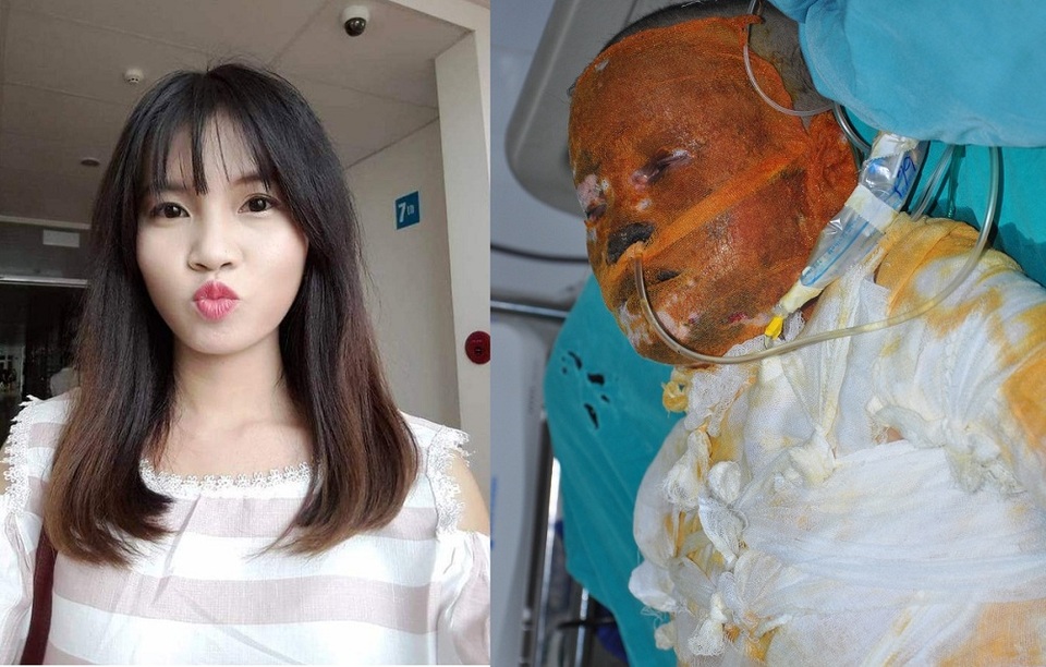 Vừa tốt nghiệp ra trường, nữ sinh gặp tai nạn bỏng xăng kinh hoàng - 7 Gương mặt xinh đẹp và nụ cười kia giờ đã không còn nữa.