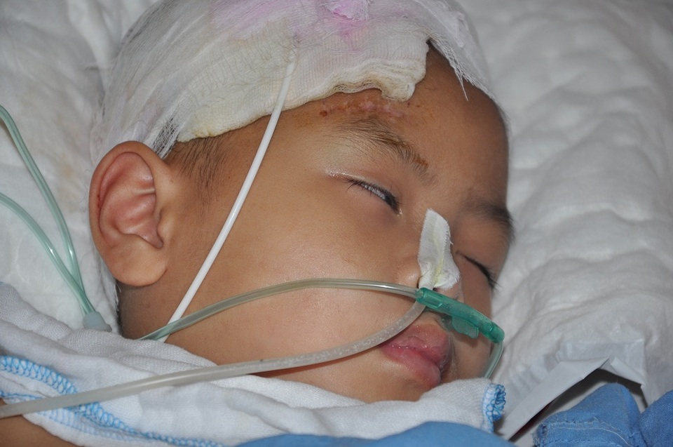 Bị chú họ vô tình dùng súng bắn vào đầu khiến bé Tuấn Anh phải cấp cứu tại bệnh viện Việt Đức.