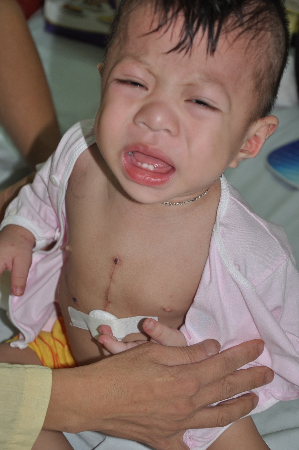 19 tháng tuổi Hải đã trải qua 2 lần phẫu thuật tim.