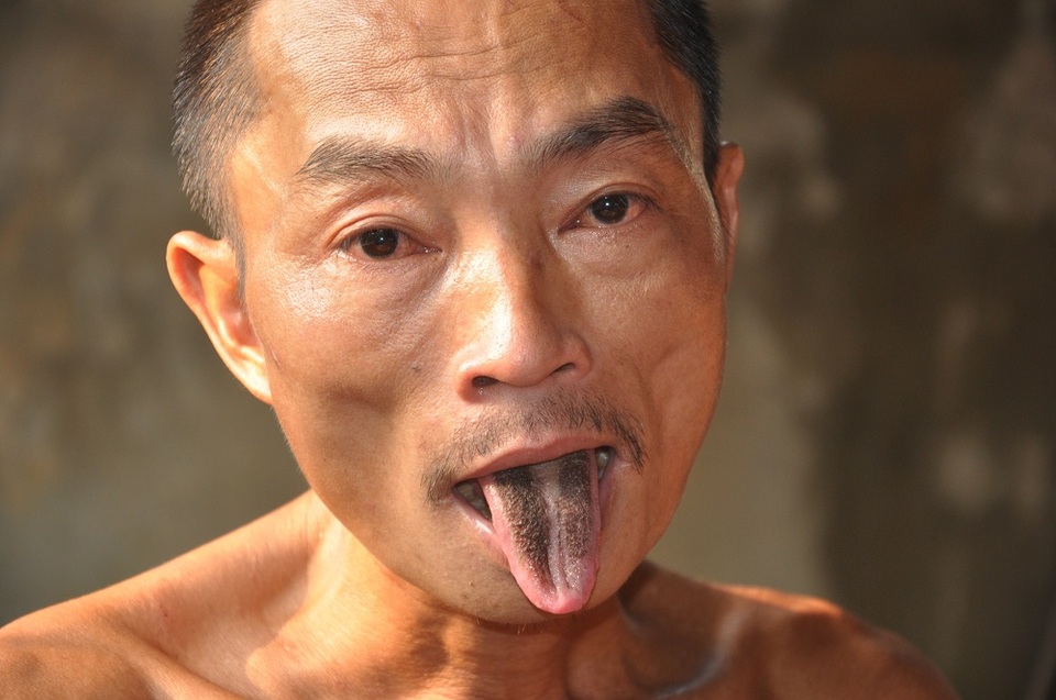 Người anh nhiều mụn nhọt và phần lưỡi đen xì kể từ khi bị bệnh.