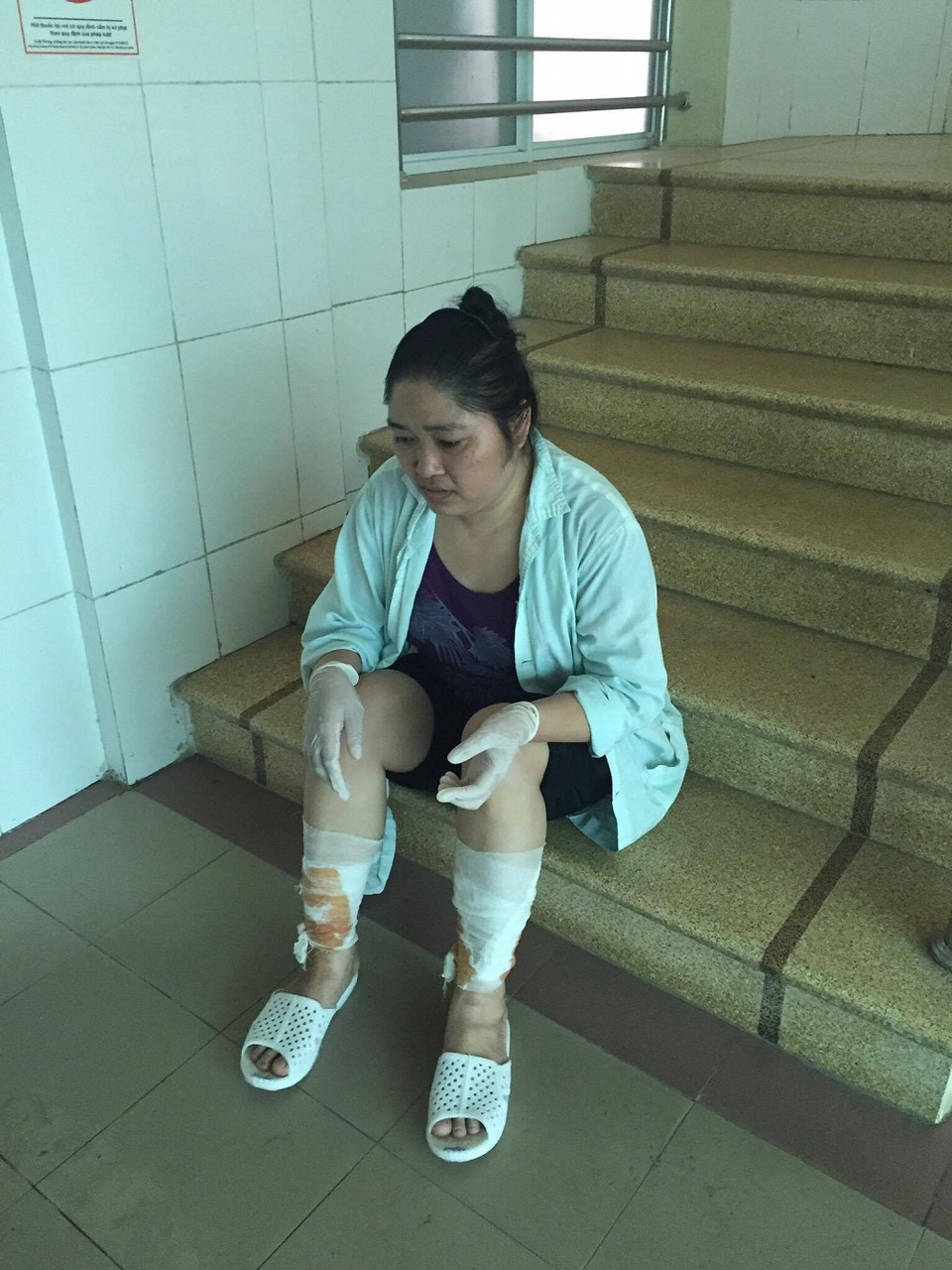 Lao vào cứu con, 3 người trong gia đình cùng bị bỏng nặng - 4 Nhiều lúc đau quá chị phải ngồi phịch xuống đất để nghỉ ngơi.
