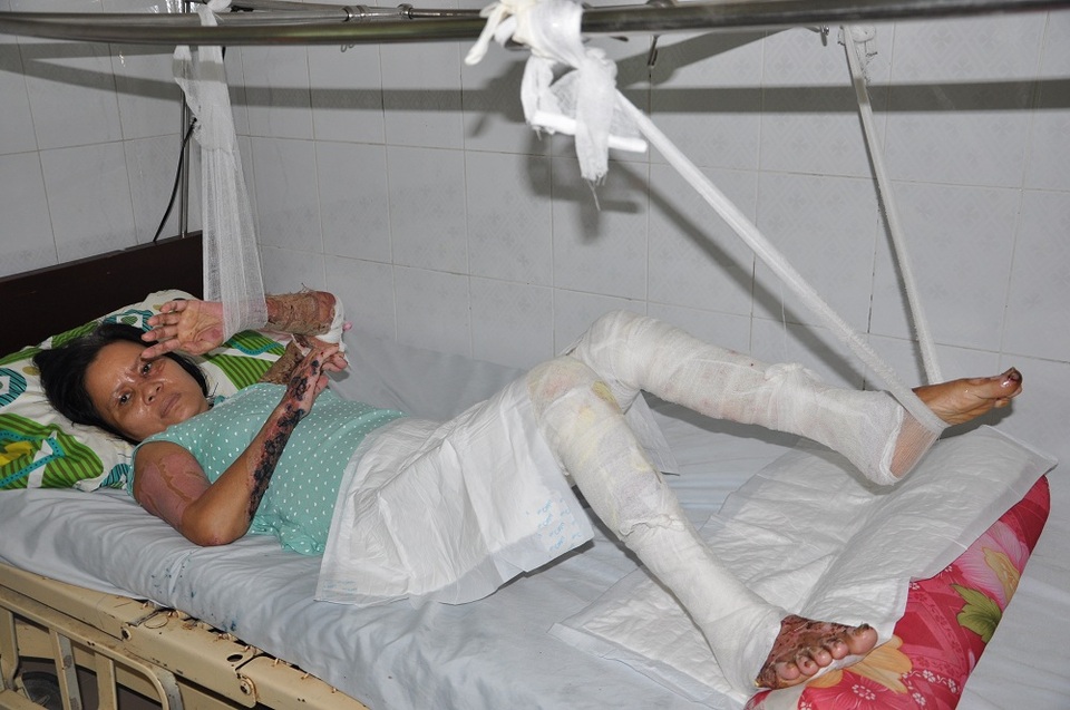 Cô Hồng - Mẹ của em Hằng đang điều trị tại tầng 5, Viện Bỏng quốc gia.