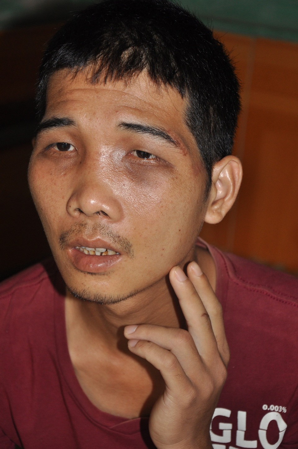 
Em An là em trai Nhường đã thoát chết nhưng sắp tới em phải mổ để cố định lại xương hàm.
