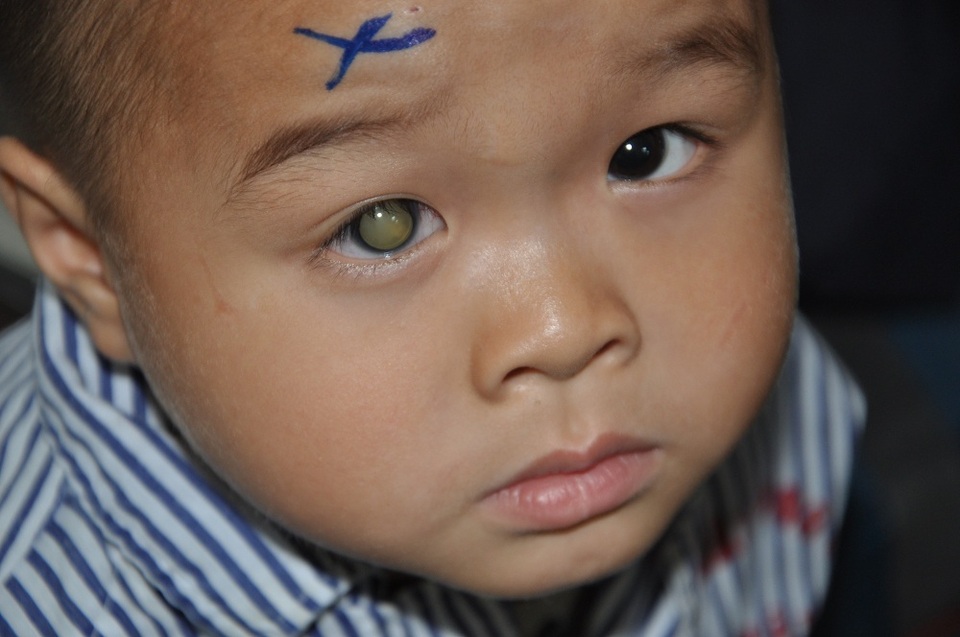 4 tuổi cậu bé Trương Văn Lanh được chẩn đoán ung thư võng mạc.