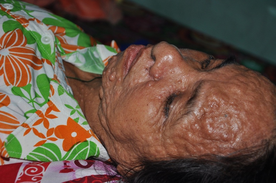 Chị Làn đau đớn với căn bệnh nhưng không có tiền xạ trị.