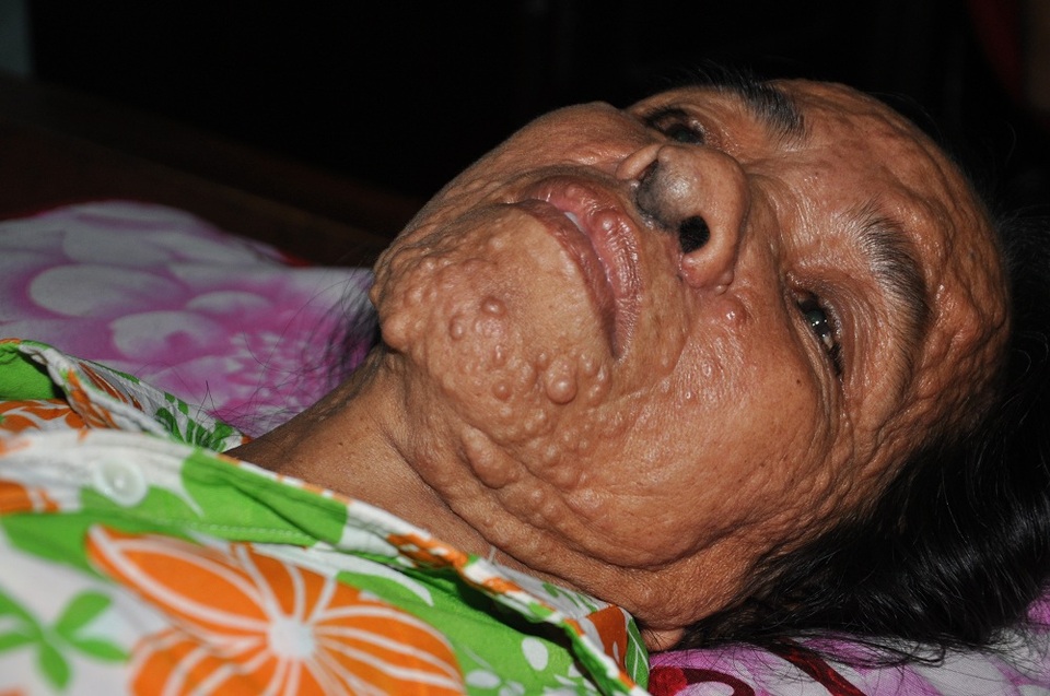 Sự sống của chị Làn đang bị đếm ngược từng ngày.