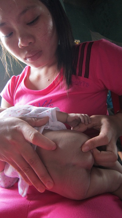 Nước mắt buồn bé 3 tháng tuổi không hậu môn, tim bẩm sinh  - 3