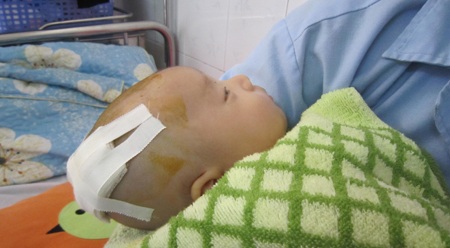 Người lớn đánh nhau, bé 2 tháng tuổi bị lún sọ não - 1