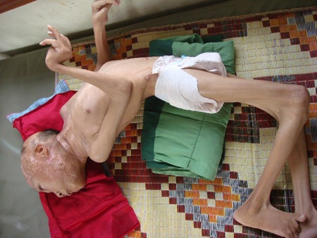 hay lở loét thân mình...