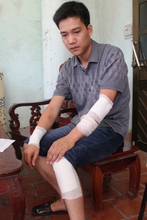 Anh Nguyễn Công Hiệp bị một vết chém dài 12cm ở cánh tay phải và nhiều vết thương khác