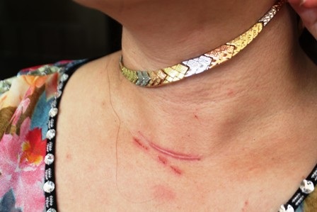 Dấu vết còn trên cổ chị Dung sau khi đối tượng giật sợi dây chuyền không thành
