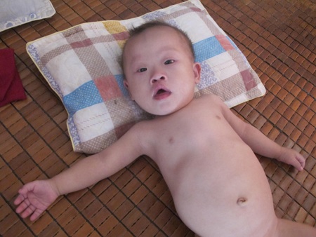 Xót lòng bé 11 tháng tuổi thoi thóp vì chứng bệnh down và tim bẩm sinh phức tạp - 1 Xót lòng bé 11 tháng tuổi thoi thóp vì chứng bệnh down và tim bẩm sinh phức tạp