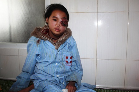 Mắt bên trái của Gồ như chực nổ tung vì bị khối u chèn ép.