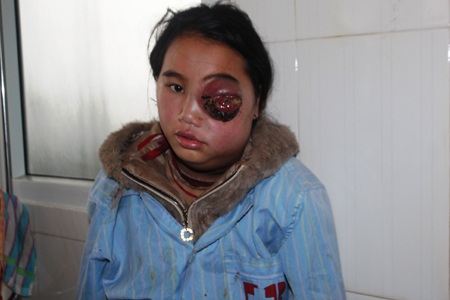 Nhà nghèo, không có tiền chữa trị nên Gồ đang bị căn bệnh quái ác hành hạ đau đớn.