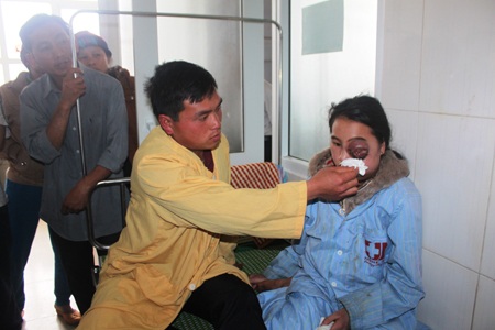 Gồ bị khối u chèn ép đến độ con mắt như muốn nổ tung khi nào không hay.