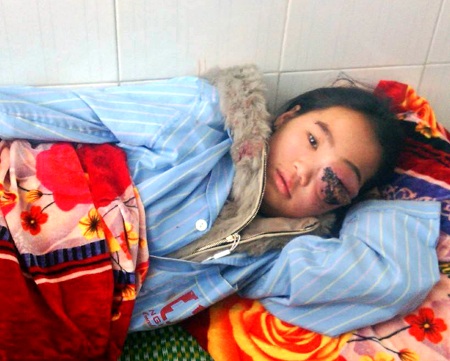 Gồ bị khối u chèn ép đến độ con mắt như muốn nổ tung khi nào không hay.