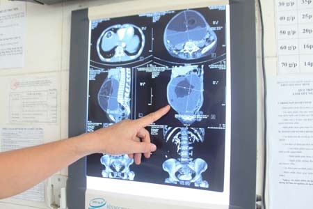 Hình ảnh chụp cắt lớp phát hiện khối u trong ổ bụng bà C.