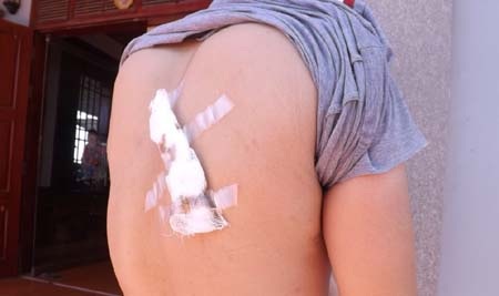 Nữ sinh bị “bắt cóc”, lỡ kỳ thi tốt nghiệp THPT - 2 Vết thương trên người anh Linh sau khi bị Ban dùng dao chém