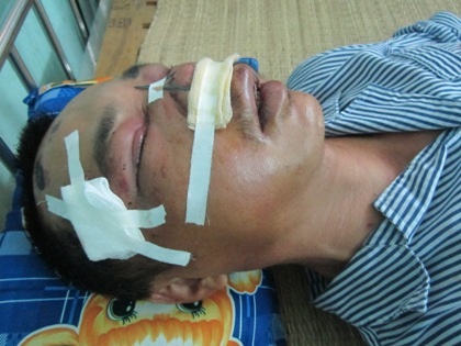 Anh Nguyễn Văn Xuân bị côn đồ ép trả tiền nhậu, đánh vỡ nát xương mặt.