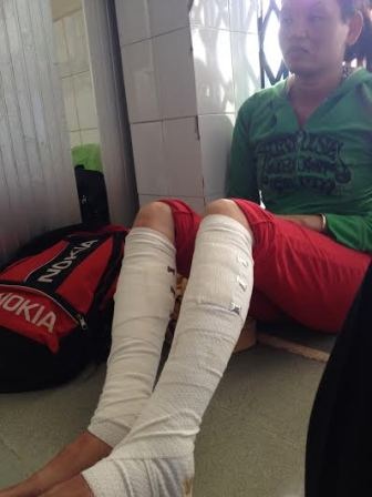 Bé gái 17 tháng tuổi bỏng nặng vì bom xăng