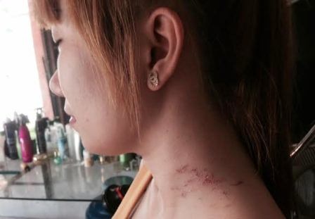 Cô thợ tóc một mình tước dao khách hàng “đầu trộm đuôi cướp” - 3 Chị H. với vết trầy trên cổ đang kể lại vụ việc chống trả tên cướp.