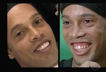 Ronaldinho khoe nụ cười sau ca phẫu thuật răng - 1 Hình ảnh của Ronaldinho trước và sau khi phẫu thuật