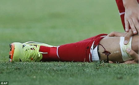 Cận cảnh chấn thương kinh hoàng của Diego Costa - 1 Diego Costa đã bị toác ống chân