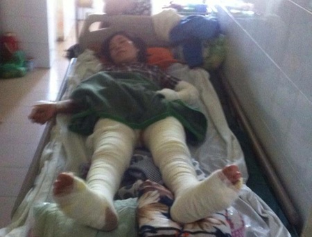 Dùng xăng tẩy nhựa đường, cả gia đình bỏng nặng - 3 Chị Tuyết bị bỏng nặng 2 chân với tỷ lệ 21%.