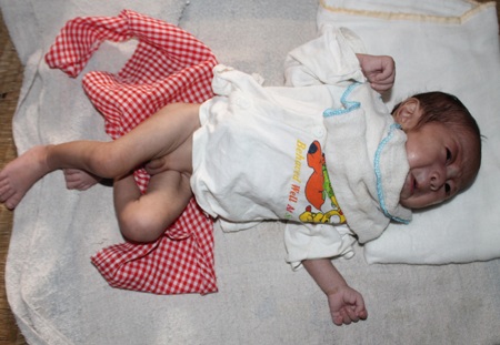 Sự sống mong manh của bé 3 tháng tuổi mắc bệnh tim bẩm sinh nặng - 4 Sự sống mong manh của bé 3 tháng tuổi mắc bệnh tim bẩm sinh nặng