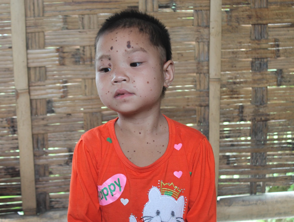 Bé Hà Thị Mai từ khi sinh ra đã mắc bệnh lạ...