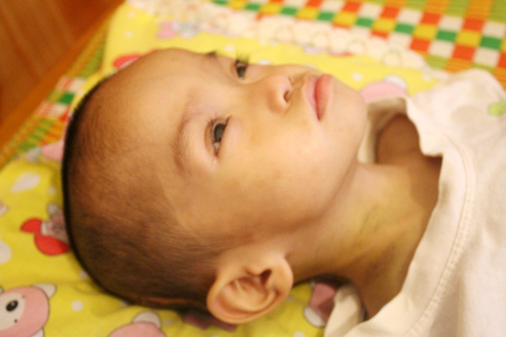 3 lần mổ não khiến cơ thể của quá yếu, các bác sỹ chưa thể can thiệp tim cho Nhật. 