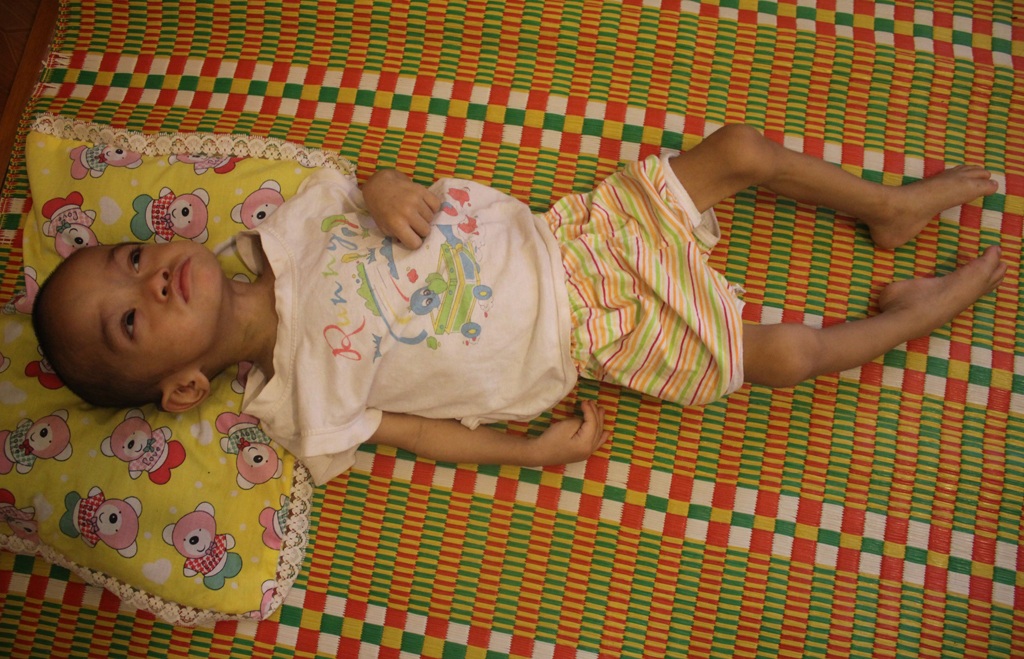 Hơn 2 tuổi, trải qua 3 lần mổ não, bé Nhật chỉ còn 8kg.