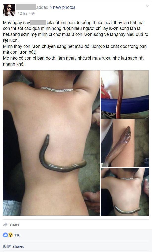 Chia sẻ mẹo hạ sốt cho trẻ bằng lươn sống: Cực nguy hiểm - 2 Hình ảnh Facebook và các hình ảnh “hút” bệnh bằng lươn được chia sẻ trên Facebook