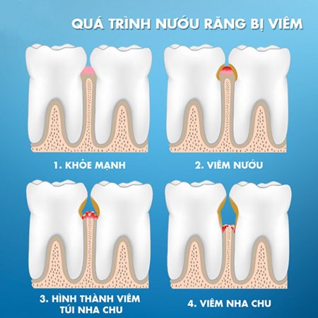 Nguy cơ mất răng vì viêm nướu - 1 Khi nướu bị viêm nặng hơn, bệnh sẽ chuyển sang giai đoạn viêm nha chu