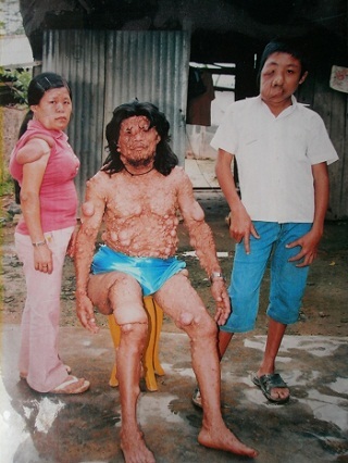 Khối u trên đầu anh Tê.